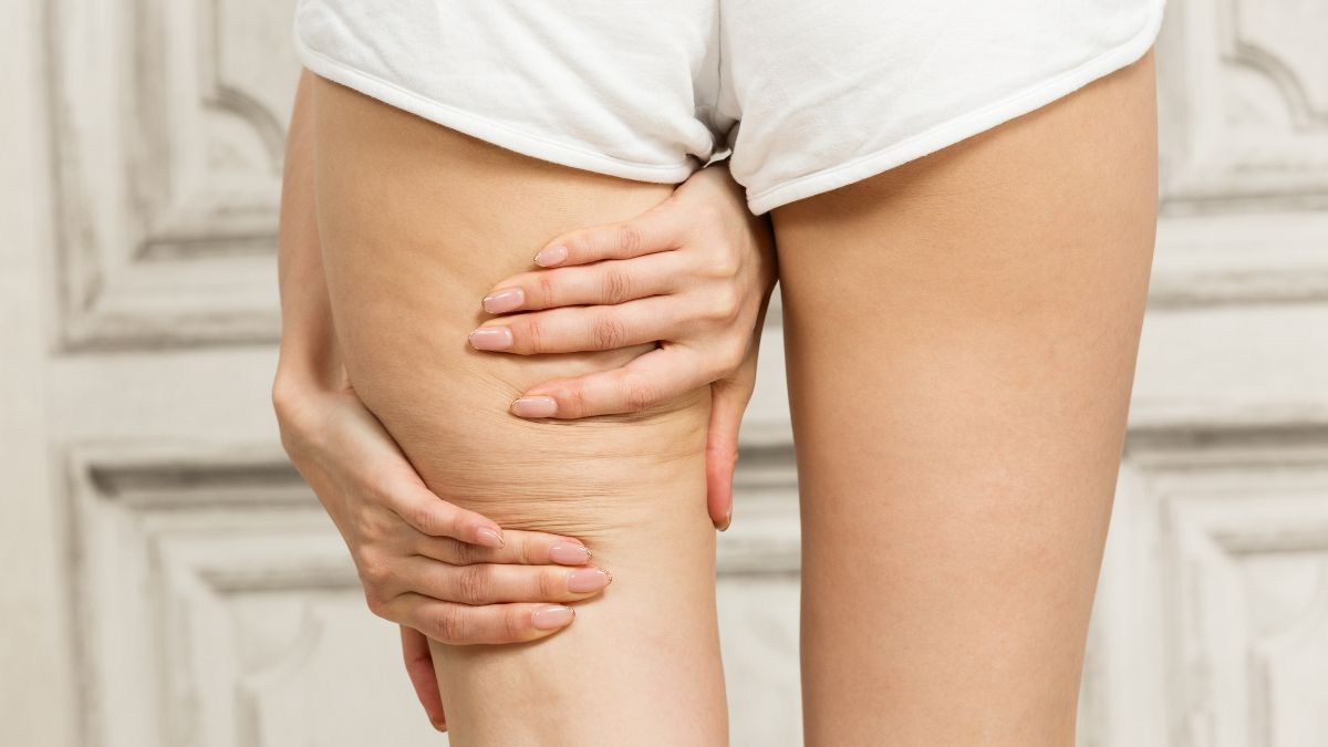 quali cibi evitare se hai la cellulite