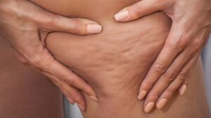 scopri se è meglio la crema o i fanghi contro la cellulite