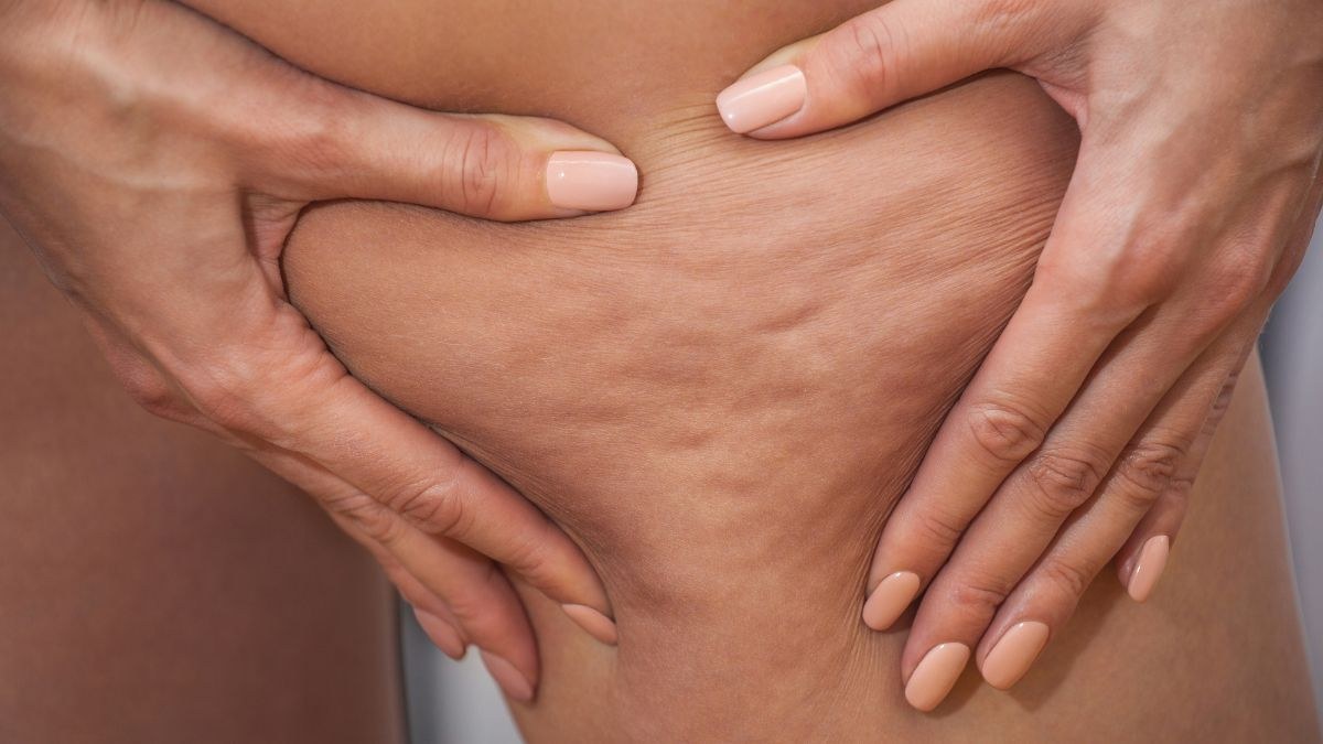 scopri se è meglio la crema o i fanghi contro la cellulite