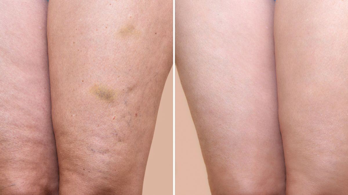 come combattere la cellulite