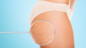 come ridurre la cellulite in modo naturale