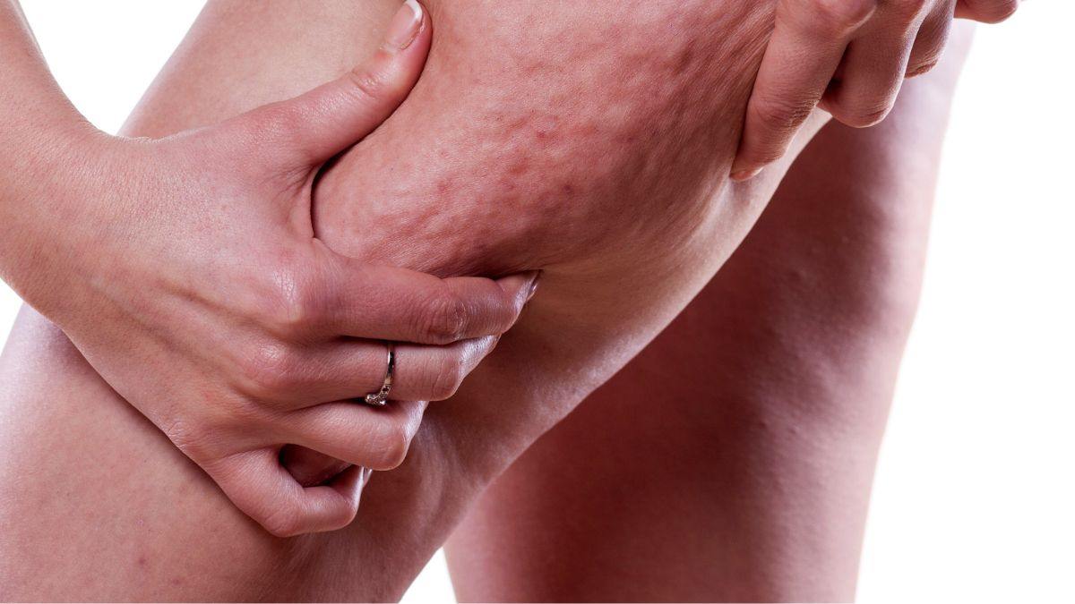 trattamento della coppettazione per la cellulite 